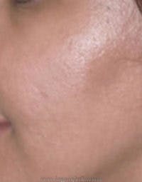 Microneedling Before & After Gallery - Patient 358028 - Image 1
