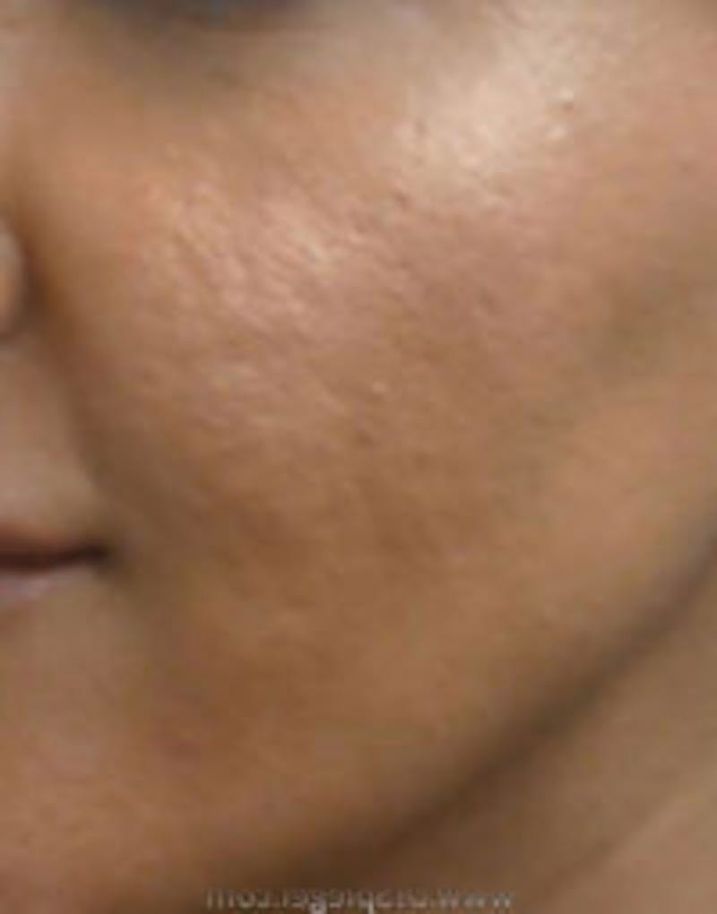 Microneedling Before & After Gallery - Patient 358028 - Image 2