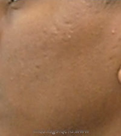 Microneedling Before & After Gallery - Patient 304805 - Image 1