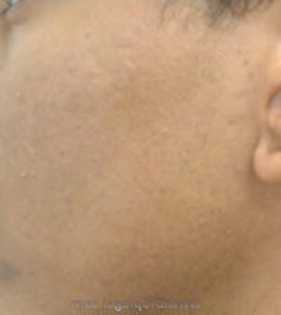 Microneedling Before & After Gallery - Patient 304805 - Image 2