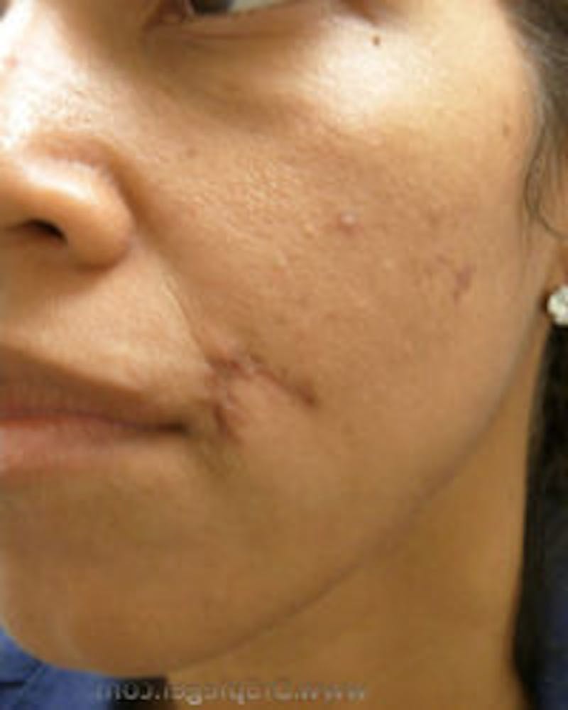 Microneedling Before & After Gallery - Patient 511512 - Image 1