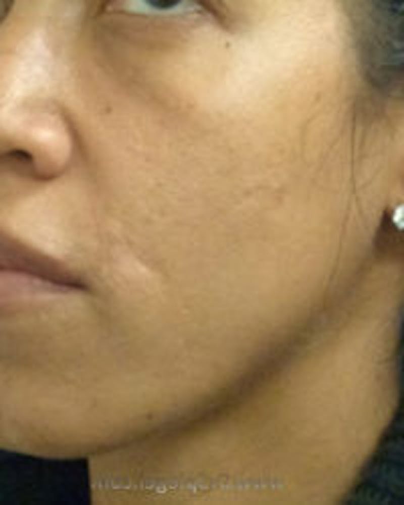 Microneedling Before & After Gallery - Patient 511512 - Image 2