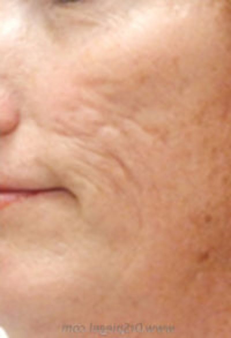 Microneedling Before & After Gallery - Patient 345003 - Image 1