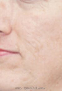 Microneedling Before & After Gallery - Patient 345003 - Image 2