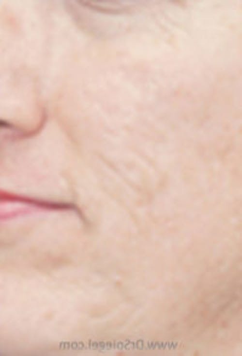 Microneedling Before & After Gallery - Patient 345003 - Image 2