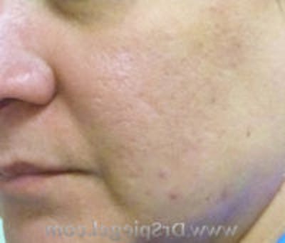 Microneedling Before & After Gallery - Patient 124755 - Image 1