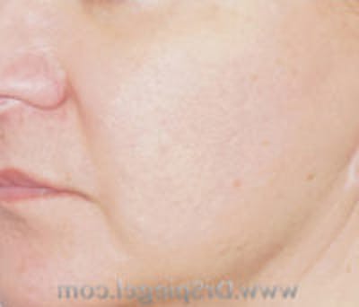 Microneedling Before & After Gallery - Patient 124755 - Image 2