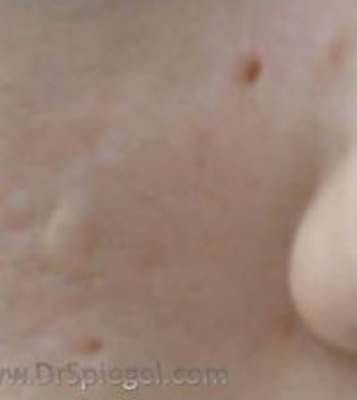 Microneedling Before & After Gallery - Patient 893457 - Image 1