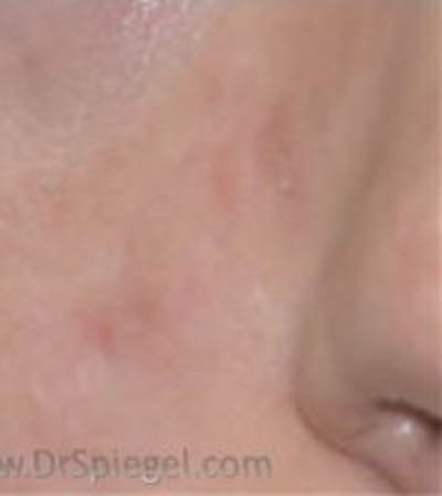 Microneedling Before & After Gallery - Patient 893457 - Image 2
