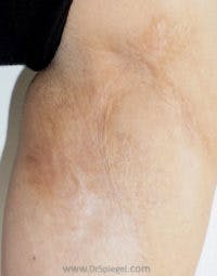 Microneedling Before & After Gallery - Patient 192193 - Image 2