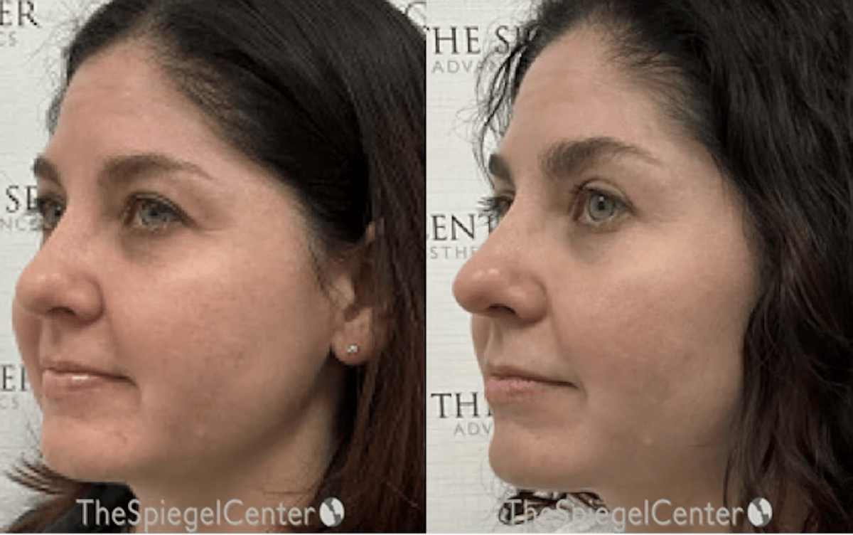 Morpheus8 Before & After Gallery - Patient 149152 - Image 1