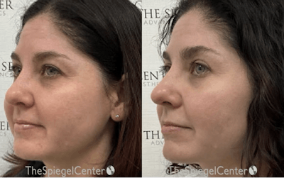 Morpheus8 Before & After Gallery - Patient 149152 - Image 1