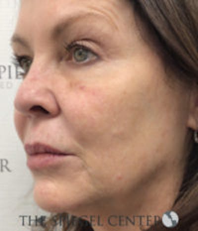 Morpheus8 Before & After Gallery - Patient 154465 - Image 1