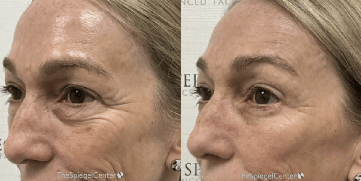 Morpheus8 Before & After Gallery - Patient 131116 - Image 1