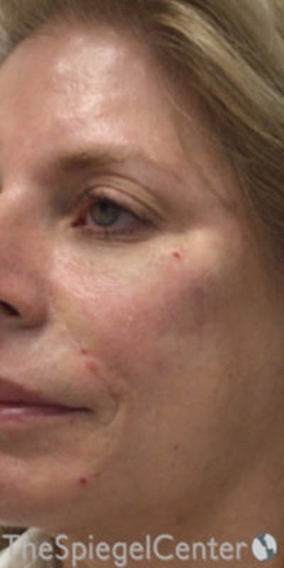 Morpheus8 Before & After Gallery - Patient 384845 - Image 1