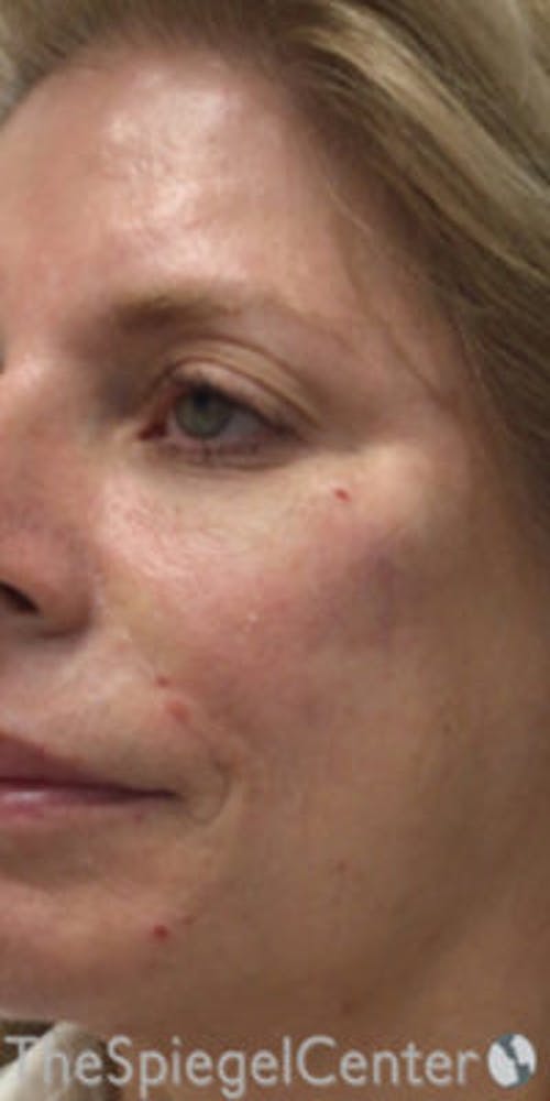 Morpheus8 Before & After Gallery - Patient 384845 - Image 1