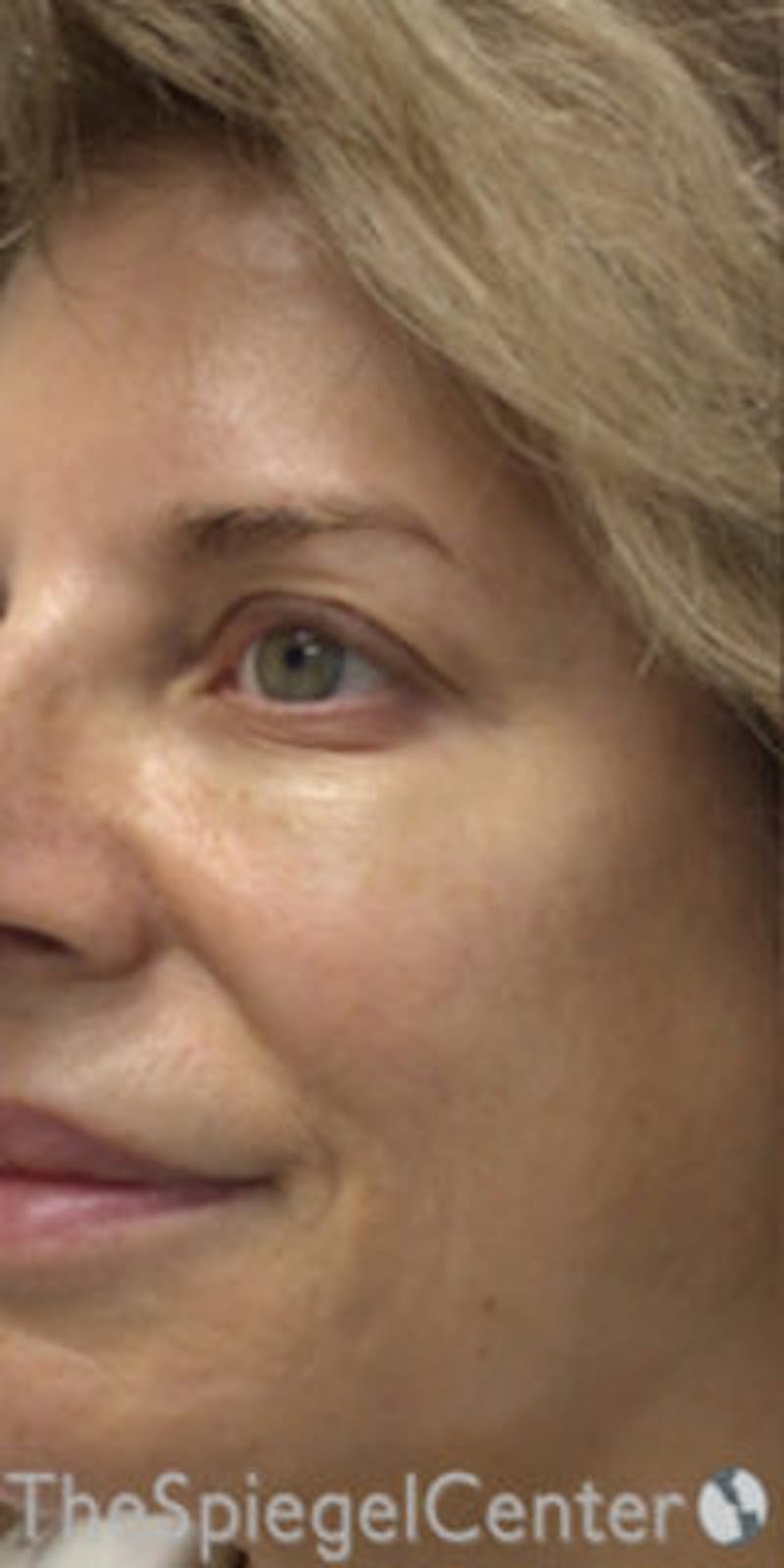 Morpheus8 Before & After Gallery - Patient 384845 - Image 2