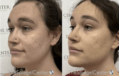 Morpheus8 Before & After Gallery - Patient 412729 - Image 1