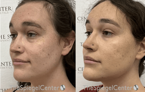 Morpheus8 Before & After Gallery - Patient 412729 - Image 1