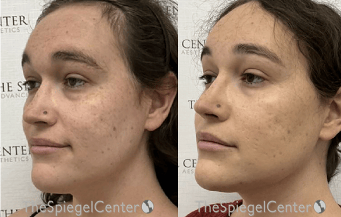 Morpheus8 Before & After Gallery - Patient 412729 - Image 1