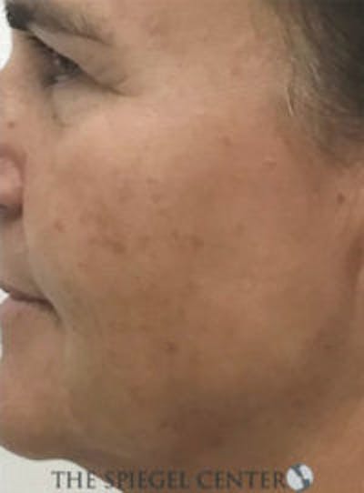 Morpheus8 Before & After Gallery - Patient 539744 - Image 1