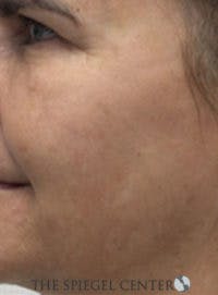 Morpheus8 Before & After Gallery - Patient 539744 - Image 2