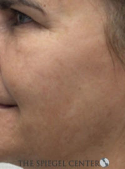 Morpheus8 Before & After Gallery - Patient 539744 - Image 2