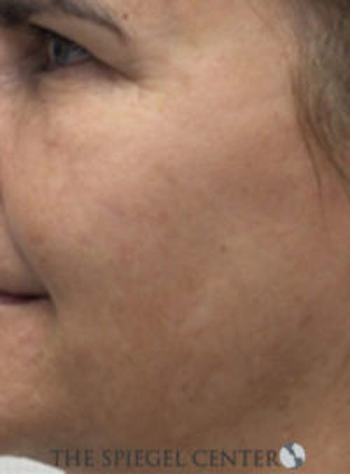 Morpheus8 Before & After Gallery - Patient 539744 - Image 2