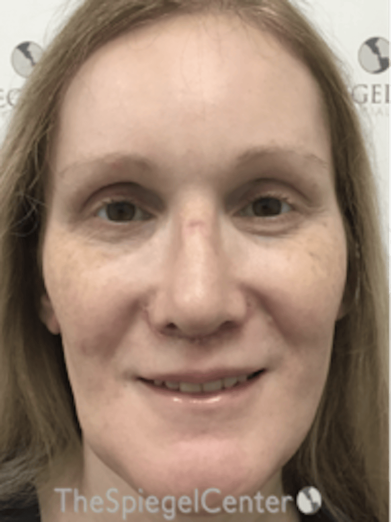 Morpheus8 Before & After Gallery - Patient 235902 - Image 1