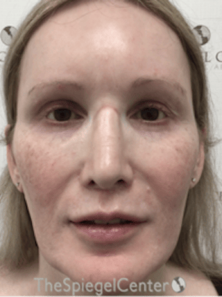 Morpheus8 Before & After Gallery - Patient 235902 - Image 2