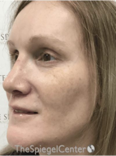 Morpheus8 Before & After Gallery - Patient 235902 - Image 3