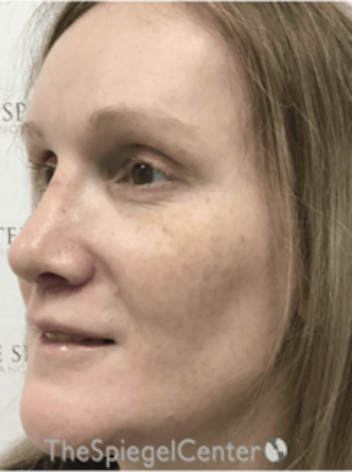 Morpheus8 Before & After Gallery - Patient 235902 - Image 3