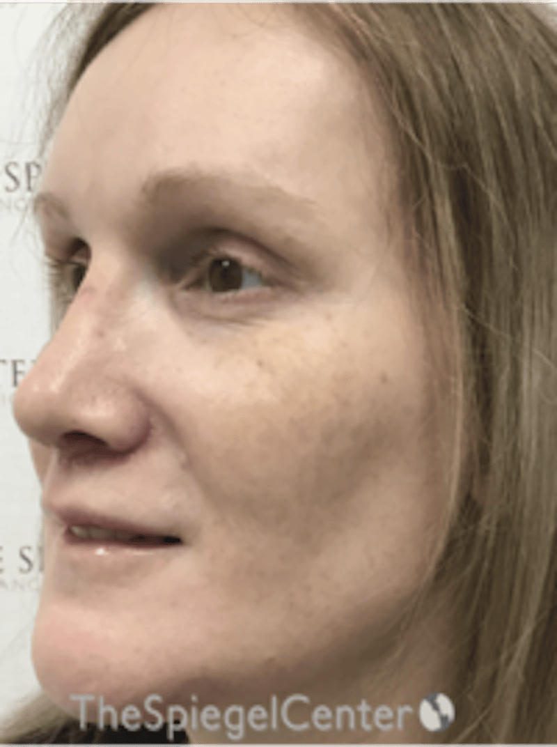 Morpheus8 Before & After Gallery - Patient 235902 - Image 3