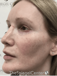 Morpheus8 Before & After Gallery - Patient 235902 - Image 4