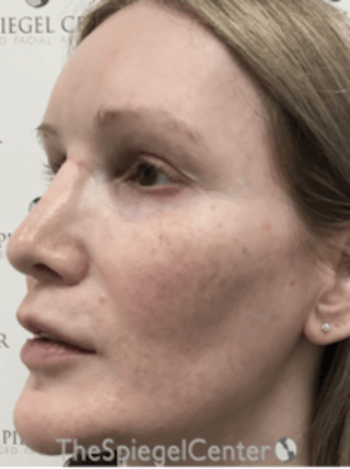 Morpheus8 Before & After Gallery - Patient 235902 - Image 4