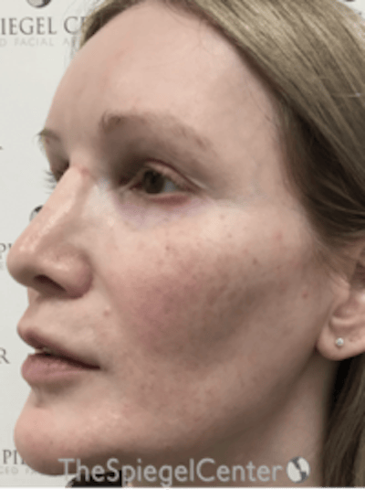 Morpheus8 Before & After Gallery - Patient 235902 - Image 4