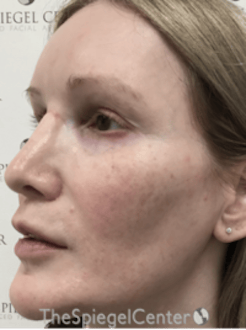 Morpheus8 Before & After Gallery - Patient 235902 - Image 4