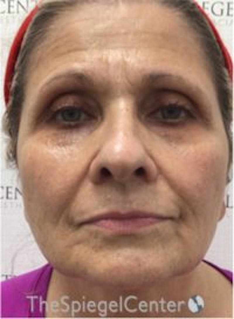 Morpheus8 Before & After Gallery - Patient 282676 - Image 1