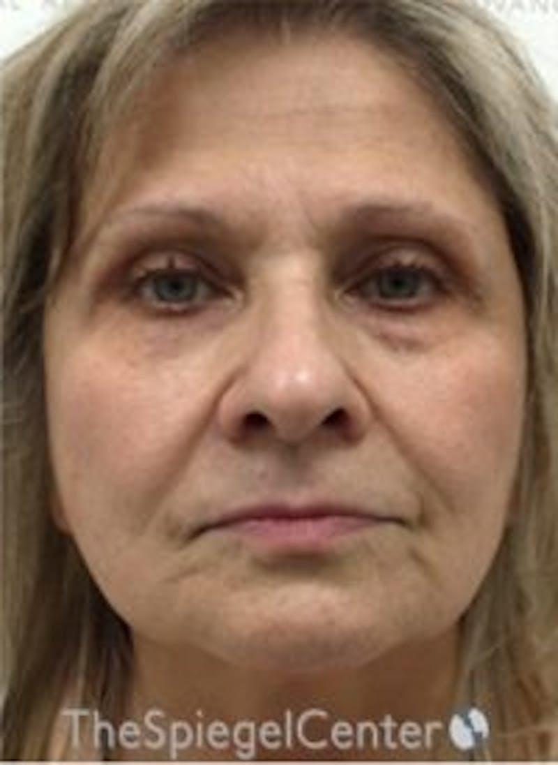 Morpheus8 Before & After Gallery - Patient 282676 - Image 2