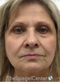 Morpheus8 Before & After Gallery - Patient 282676 - Image 2