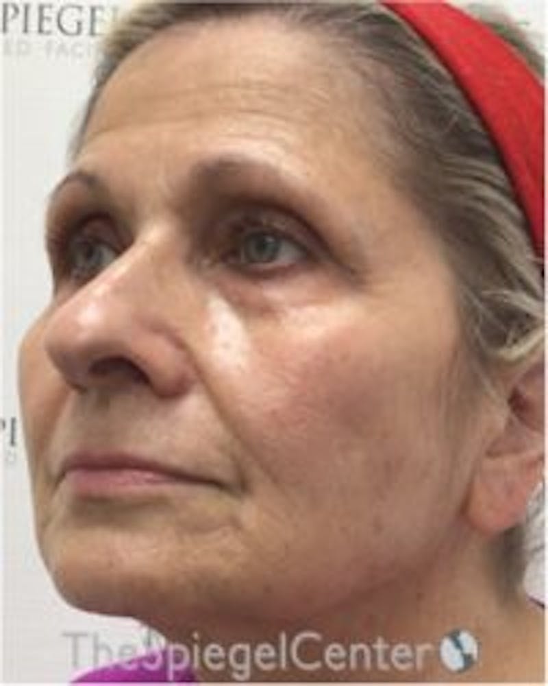 Morpheus8 Before & After Gallery - Patient 282676 - Image 3