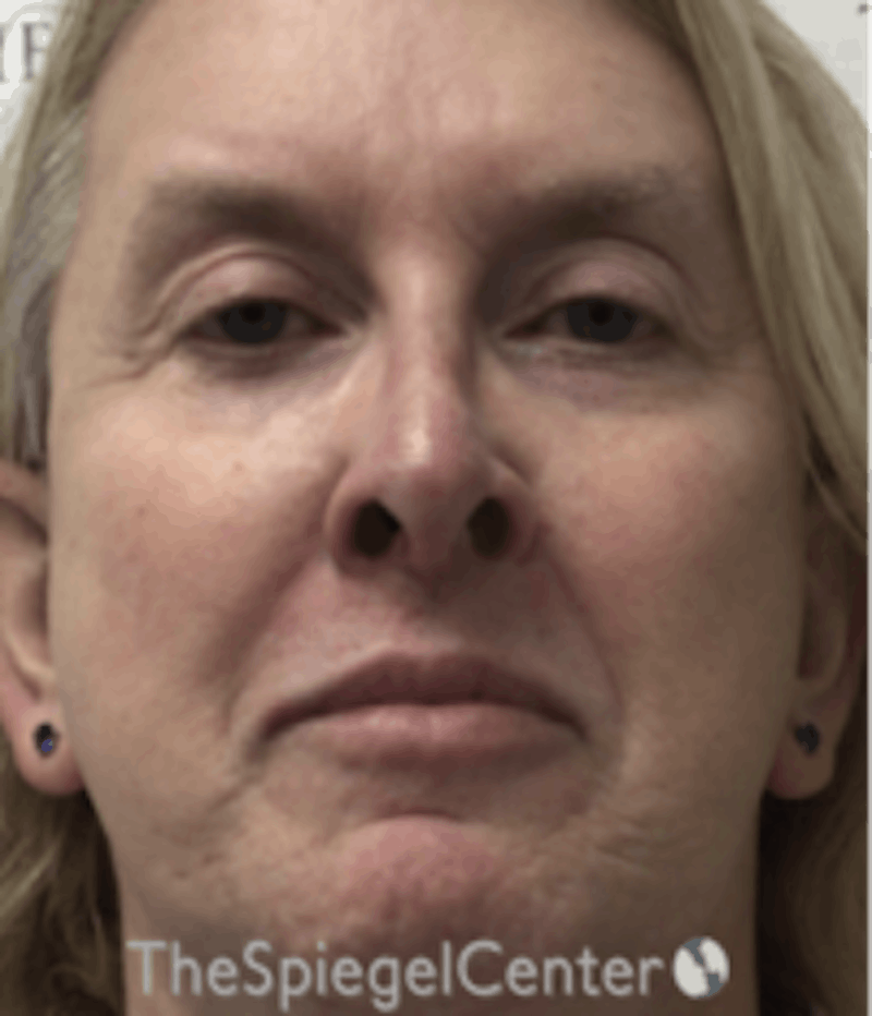 Morpheus8 Before & After Gallery - Patient 662789 - Image 1