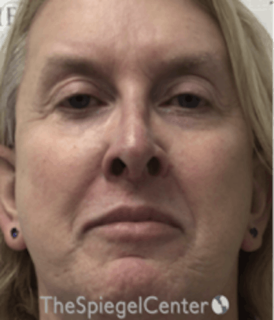 Morpheus8 Before & After Gallery - Patient 662789 - Image 1