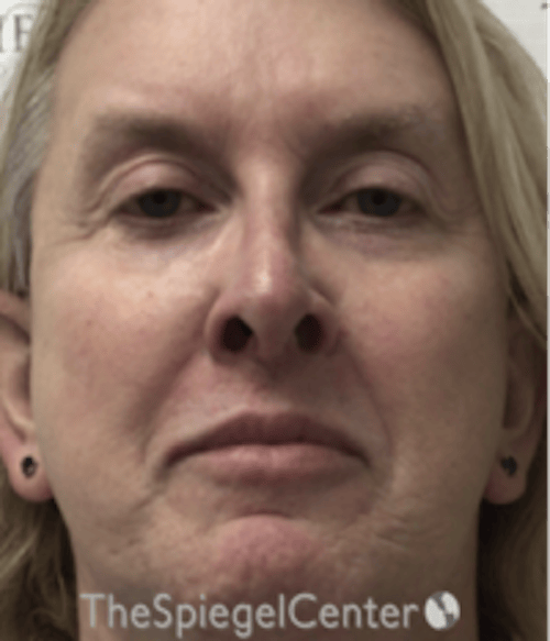 Morpheus8 Before & After Gallery - Patient 662789 - Image 1