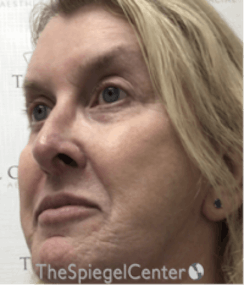 Morpheus8 Before & After Gallery - Patient 662789 - Image 3