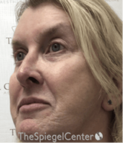 Morpheus8 Before & After Gallery - Patient 662789 - Image 3