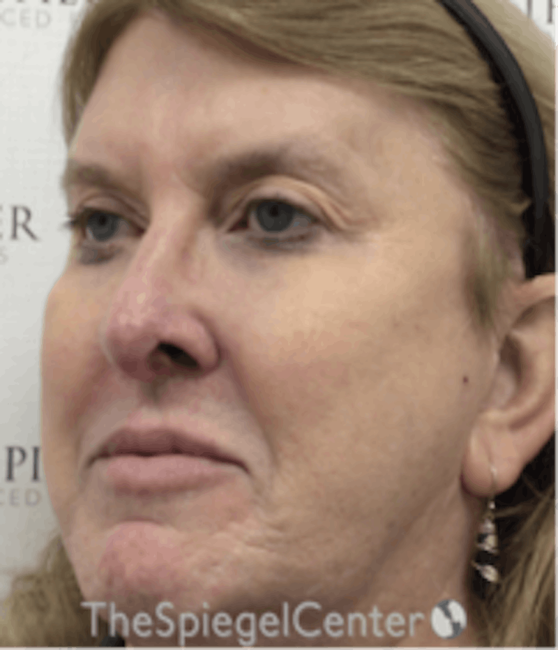 Morpheus8 Before & After Gallery - Patient 662789 - Image 4