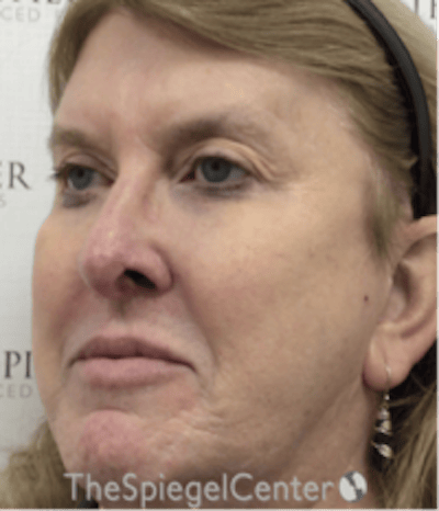 Morpheus8 Before & After Gallery - Patient 662789 - Image 4