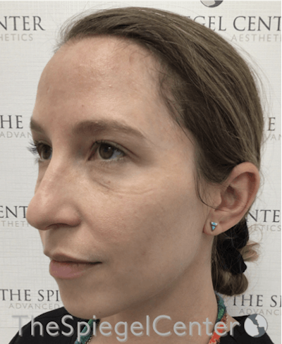 Morpheus8 Before & After Gallery - Patient 146107 - Image 1