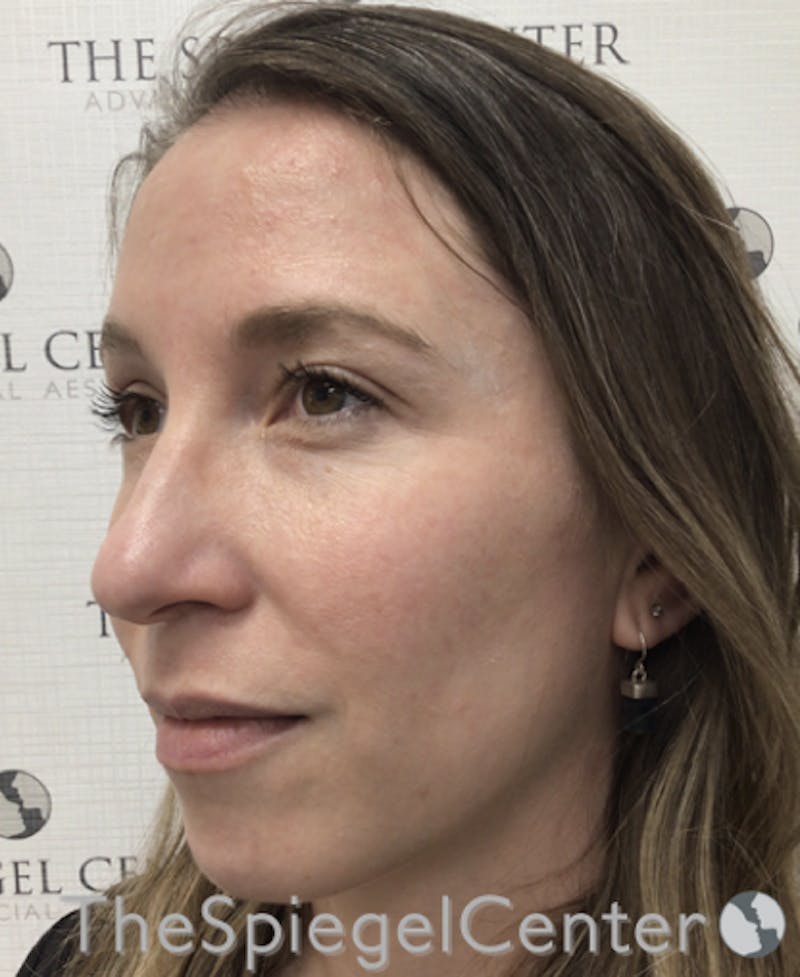 Morpheus8 Before & After Gallery - Patient 146107 - Image 2